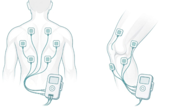 Illustration of TENS pad placement on the lower back and around the knee