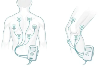 Illustration of TENS pad placement on the lower back and around the knee
